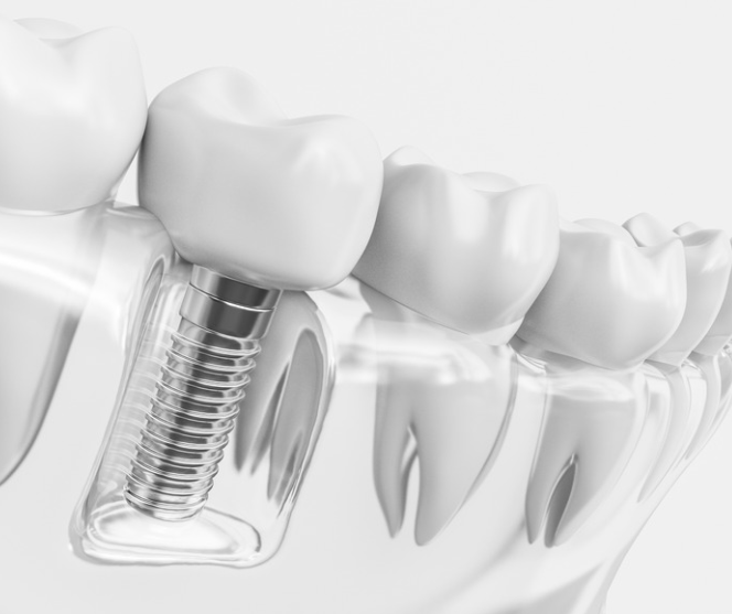 Dental Implant